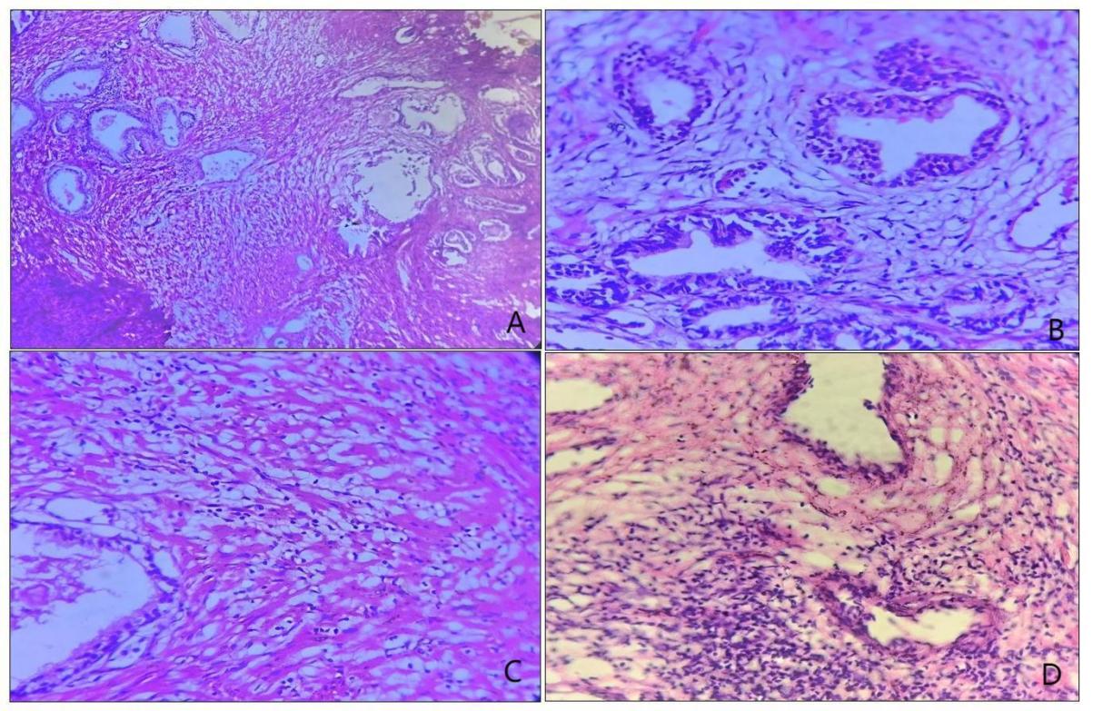 A-C: Images showing bilayered prostatic glands surrounded by sheets of histiocytes [H&E slides, A-20X, B-40X, C-40X]; D: Foci of dense lymphocytic inflammation seen surrounding the glands [H&E, 40X]