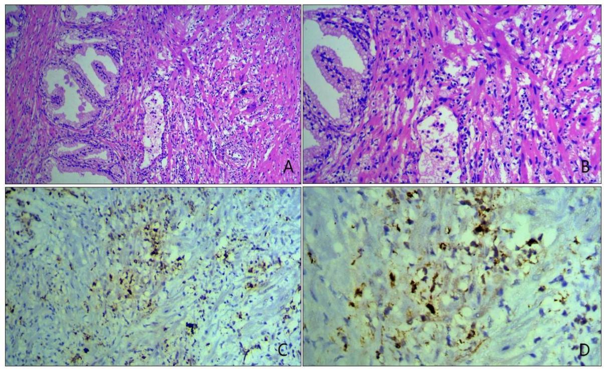 A-D:A&B showing prostatic glands surrounded by sheets of histiocytes [H&E, A-20X, B-40X];  C&D: Histiocytes showing positivity for CD 68 surrounding the glands [C- 20X, D-40X].