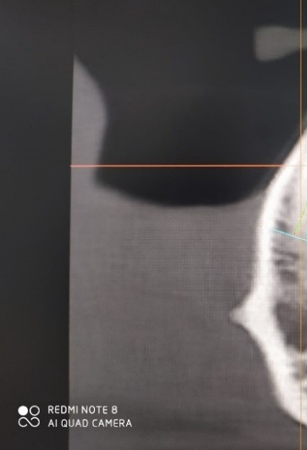 Image acquisition for the cervical, middle, and apical third of the mandibular symphysis labial cortical plate thickness.