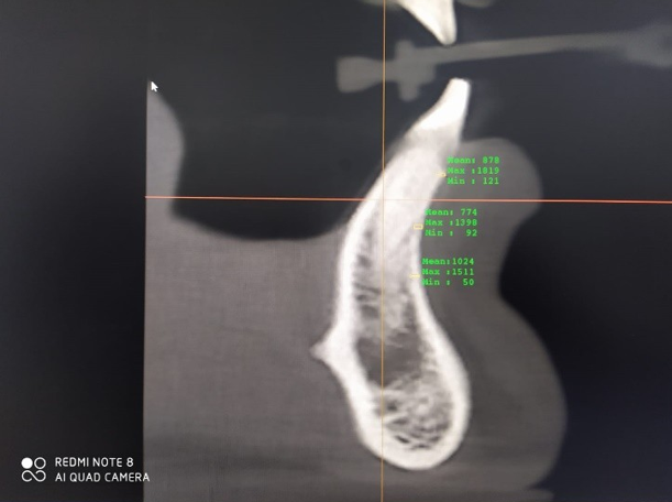 Image acquisition for thickness of bone at the mandibular symphysis's apical, middle, and cervical thirds.