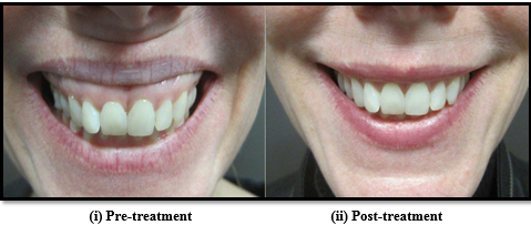 Gummy smile treated with Botox