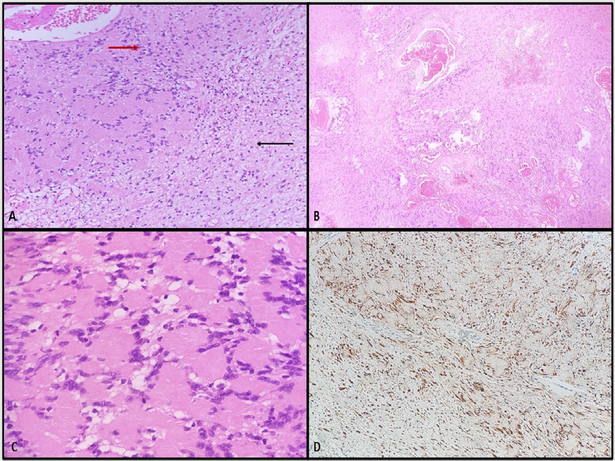 A)Section from penis with tumor showing spindle shaped cells with characteristic dense cellular Antoni A areawith nuclear palisading (red arrow) and hypocellular Antoni B areas with myxoidstroma (black arrow).