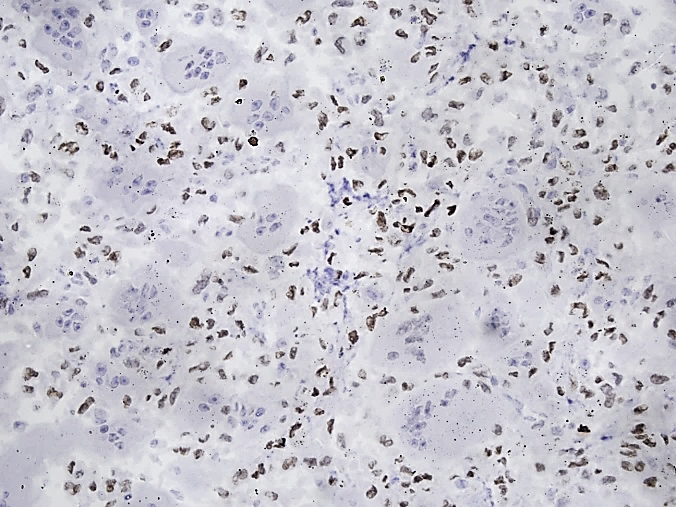 SATB2 strong diffuse nuclear positivity in tumour cells