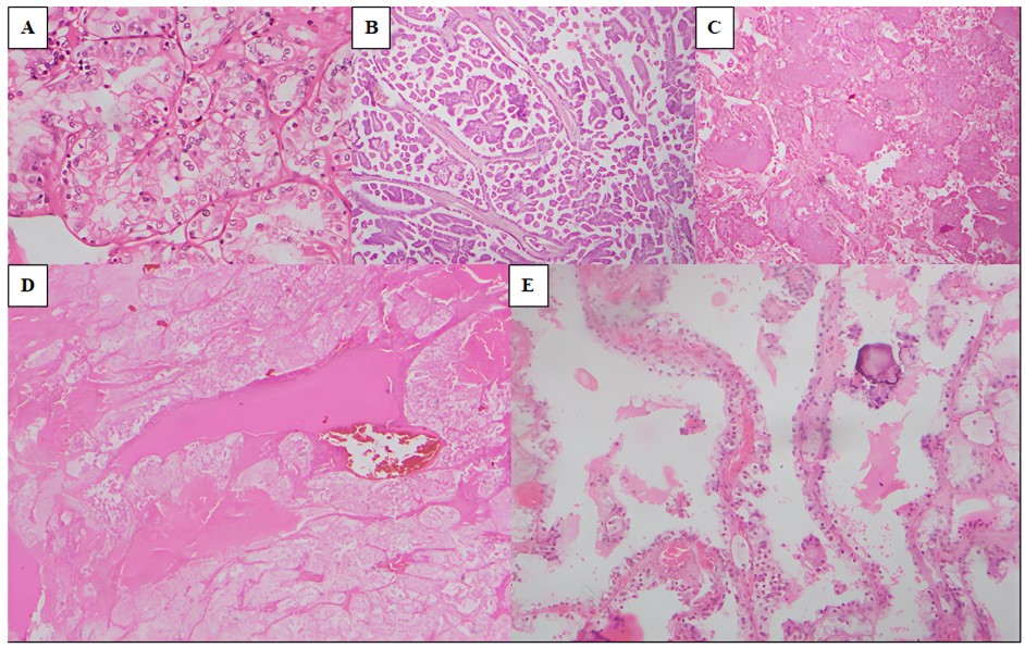 The morphological spectrum of RCC types observed in the study population; A): ccRCC (H and E x100); B): pRCC (H and E x40); C): ChRCC (H and E x40); D): ESC-RCC (H and E x40); E): MCNLMP (H and E x100)