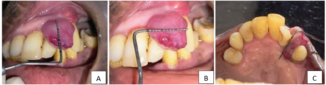 Represents the size of the lesion A), B): Buccal, C): Palatal