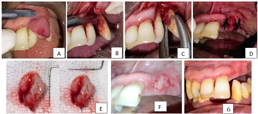 A): Incision made using No. 15 sterile surgical blade, B): Full thickness mucoperiosteal reflection and excision of the lesion, C): Extraction of 22,23, D): Flap approximation and suturing using 3-0 braided black silk, E): Excised lesion, F): Post-operative healing after 1 week after suture removal, G): Post-operative healing after 1 month