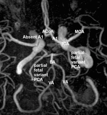 MRA image showing an incomplete circle of Willis (both anterior and posterior parts). In the anterior part, A1 segment absent on right side 