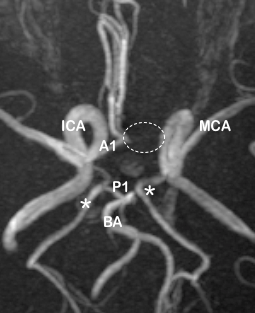 Incomplete circle of Willis: absent left A1 (dotted circle) in the anterior part