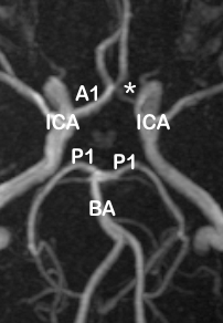 MRA image showing left A1 hypoplasia (*) with fused ACA