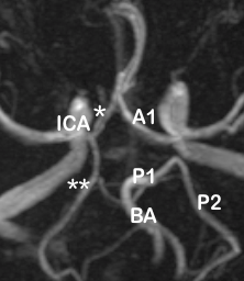 MRA image of circle of Willis showing duplication of right A1 (*)