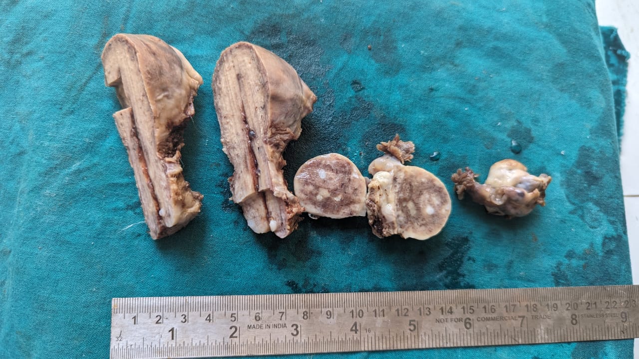 Gross picture showinguterocervix with bilateral ovaries and fallopian tubes. Enlarged right ovary showing smooth external surface and solid tan-white homogeneous cut surface.
