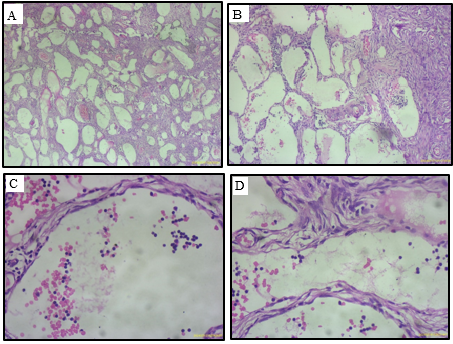 A and B: Microscopic picture showing tumor composed of spaces and clefts; C and D: Microscopic picture showing low columnar, and flattened epithelial-like cell lining.