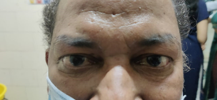 53 year old male with bilateral chemosis and mild facial puffiness