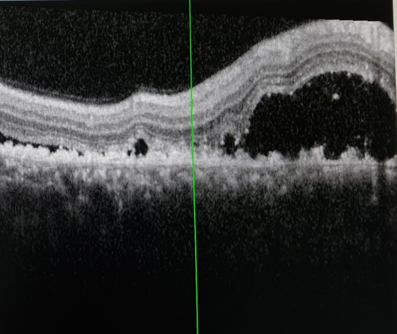 This OCT image explains multiple exudative detachment and central serous retinopathy