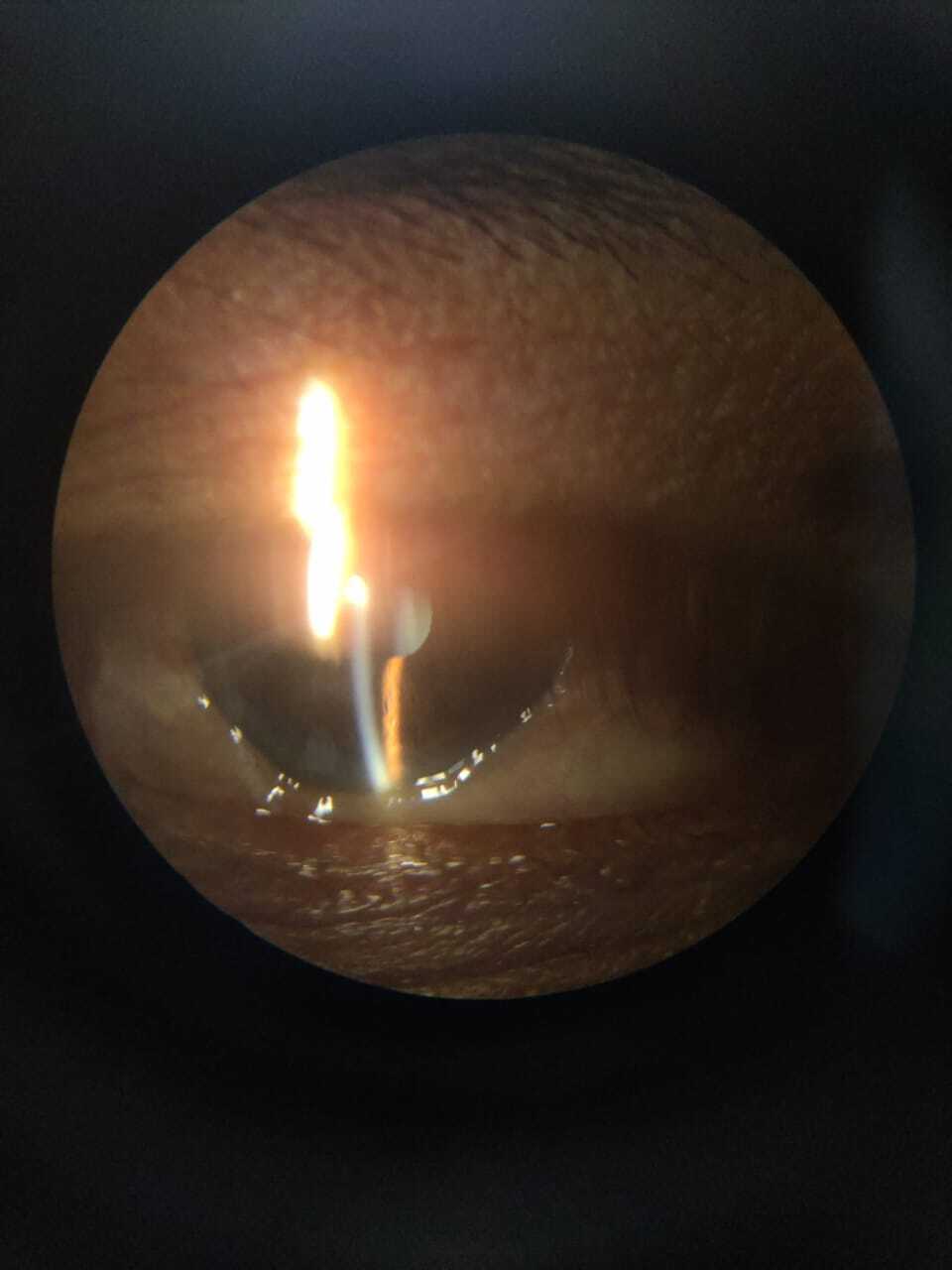 Slit lamp photo showing conjunctival chemosis