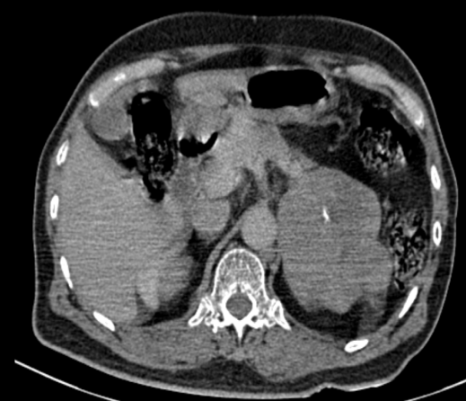 Cross sectional CT imaging at the level of adrenal gland shows large lobulated heterogeneously enhancing soft tissue density lesion with calcific foci in the suprarenal location