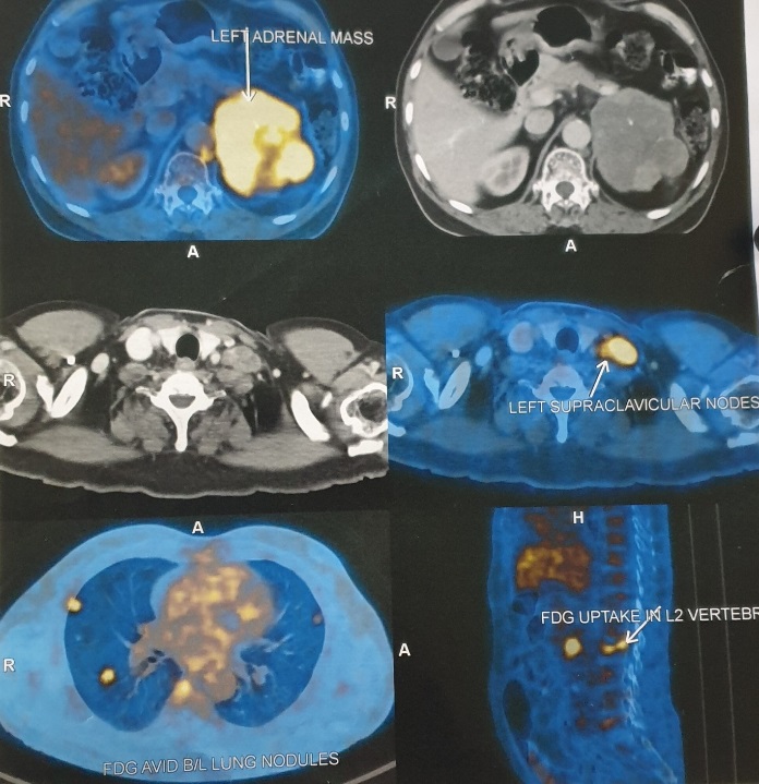 This image shows PET scan with increased upatake in left adrenal gland, bilateral lung nodules , left supraclavicular lymph node and L2 vertebrae