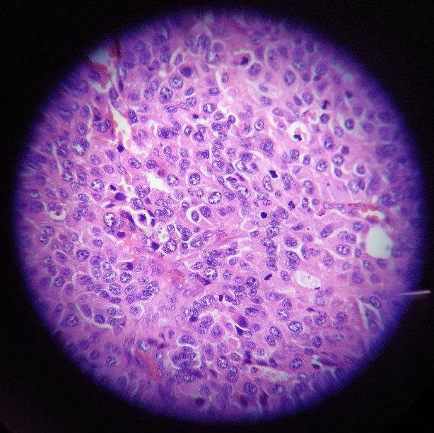 Cervical lymph node biopsy 40x shows complete effacement of architecture, composed of cells arranged in nests, individual cells moderately eosinophilic, clear cytoplasm,pleomorphic vesicular nucleus,high mitosis 6-7/hpf