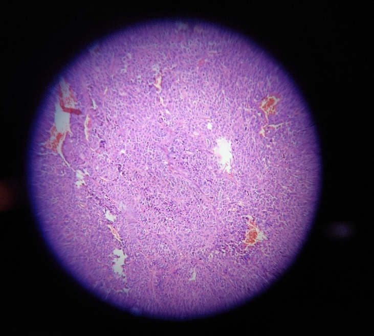 Cervical lymph node biopsy 10x shows areas of hemorrhages in multiple areas