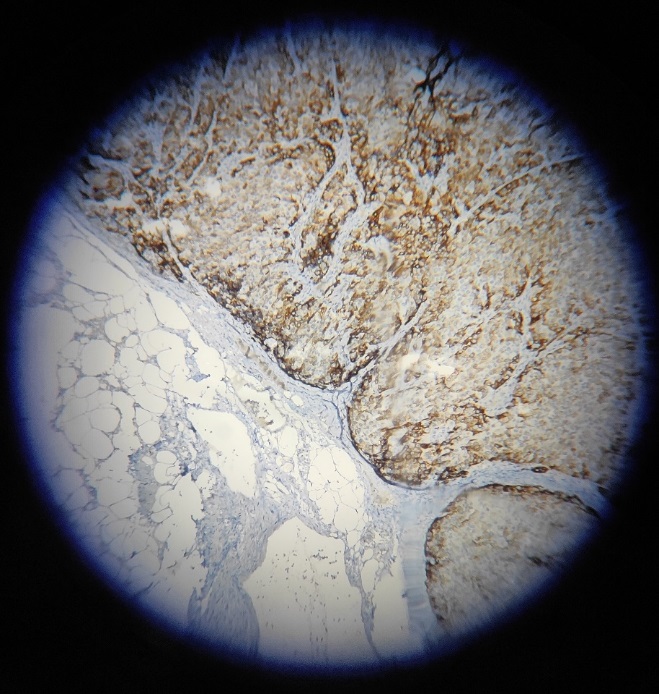 cervical lymph node biopsy shows inhibin A positivity