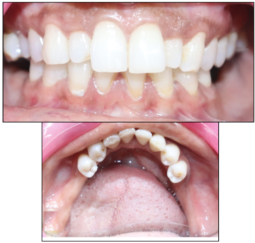 Pre-Treatment