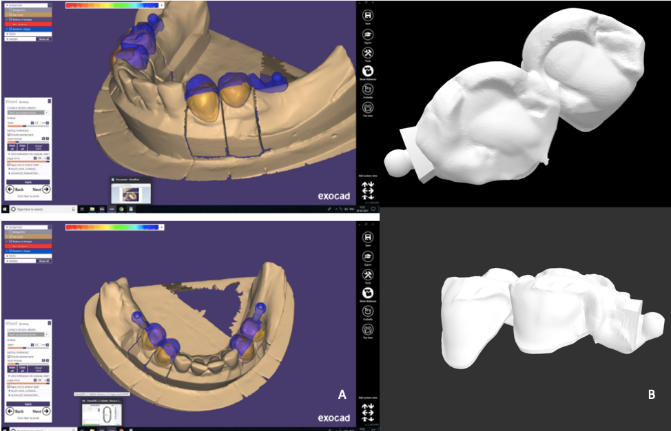 A: Incorporating Rhein 83 attachment using Exocad software; B: STL file generated