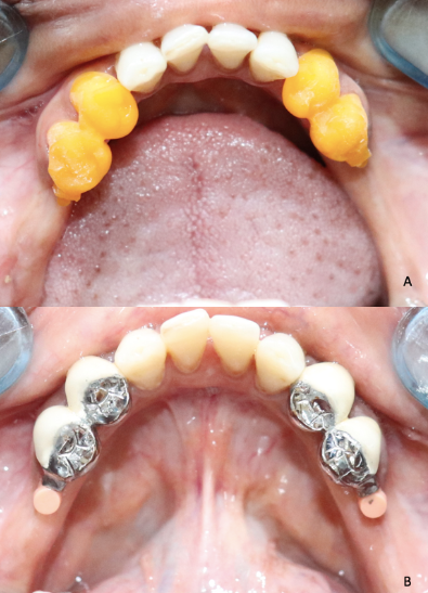 A: Intra-oral trial of crown attachment resin assembly; B: Intra-oral trial of cast crown attachment assembly