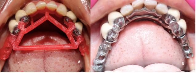 A: Intra-oral trial of 3D printed resin framework; B: Trial of conventionally cast metal framework