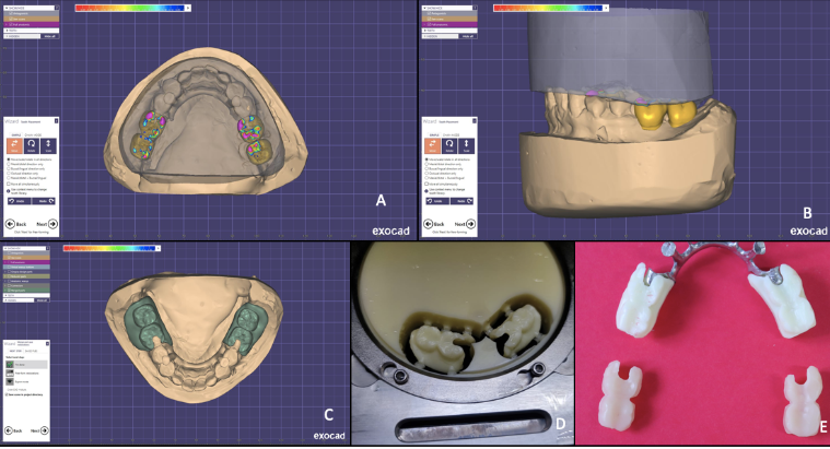 A: Teeth arrangement using Digital software; B: Checking Occlusion with opposing stone core; C: Defining denture base regions in digital software; D: Milling denture base and teeth as a single unit in wax disk; E: Additional milling of teeth using HIPC disk