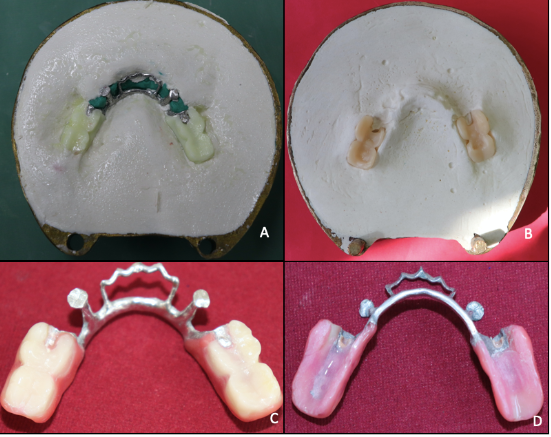 A;B: Flasking wax assembly with metal framework and placing milled teeth in occlusal indentation in counterflask after dewaxing; C,D: Finished and characterised prosthesis
