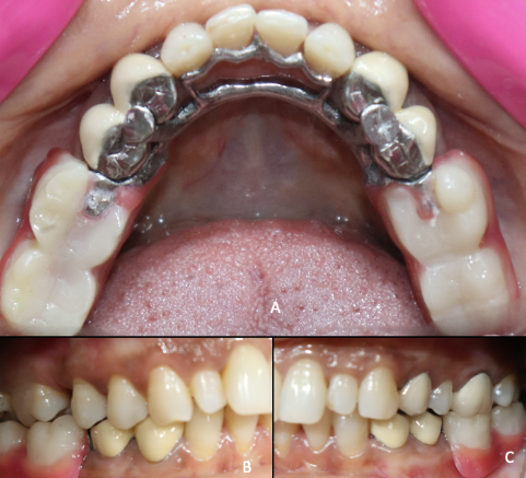 Intra-oral view of prosthesis In-Situ
