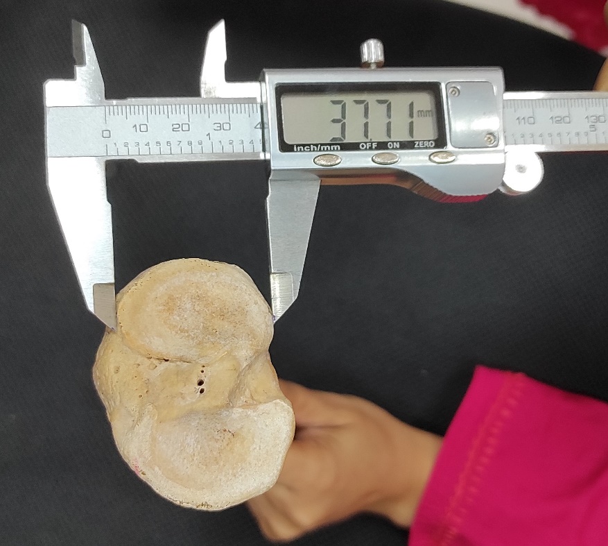 Showing measurements of antero-posterior diameter of superior articular surface of lateral condyle of right tibia by digital slide calliper