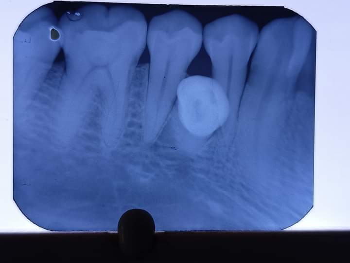 Radiograph showing supernumerary tooth