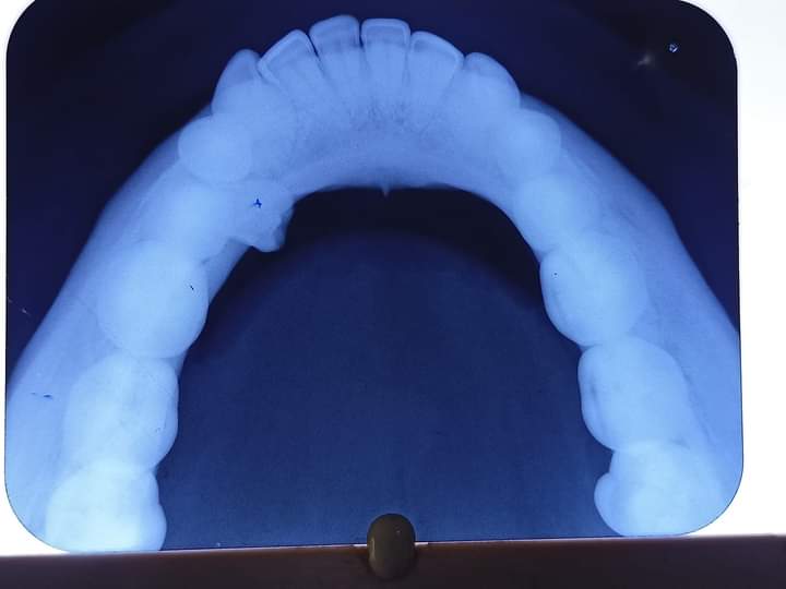 Radiograph showing supernumerary tooth present between 44 and 45