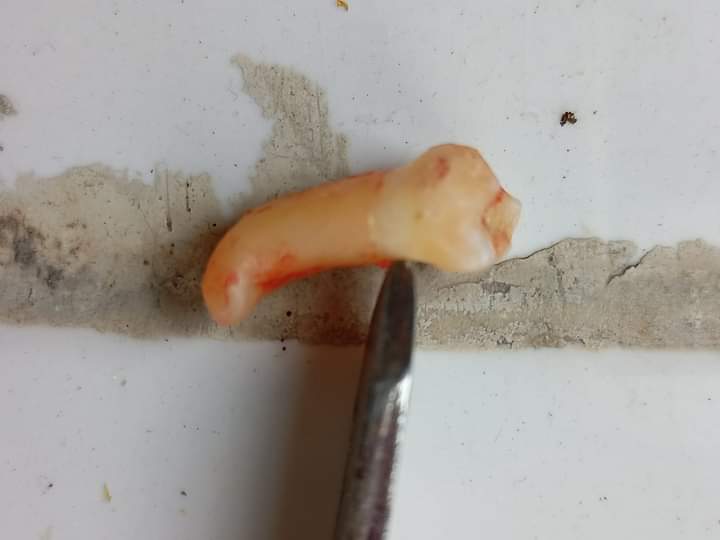 Picture showing dilacerated root of supernumerary tooth