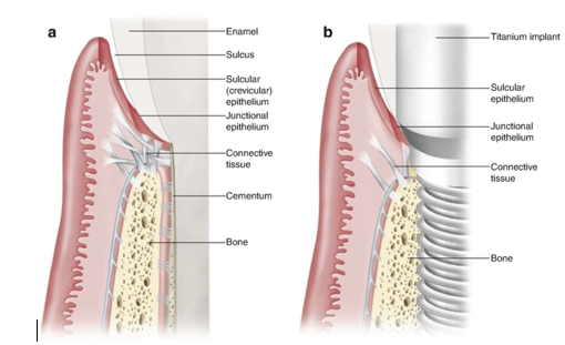 Differences between natural tooth and implants