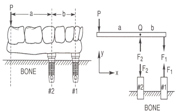 Antero-posterior distance for cantilever
