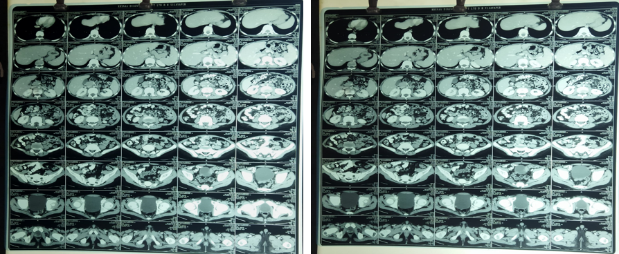 CT scan of abdomen showing diffuse wall thickening of rightileocolic junction and distal ileum