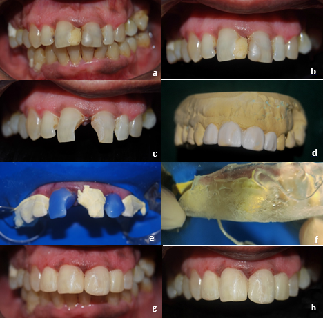 Case 1 a,b: Pre-op photographs; c: After removal of fractured restorations and caries; d: Diagnostic wax mock-up done; e: Alternate tooth etching done under split rubber-dam; f: Transparent siloxane template placed and Flowable composite injected through the incisal vents; g,h: Post-op photographs after finishing and polishing