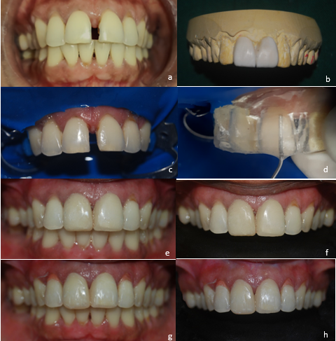 Case 2 a: Pre-op photographs; b: Diagnostic wax mock-up done; c: Under split rubber-dam; d: Transparent siloxane template placed and Flowable composite injected through the incisal vents; e,f: Post-op photographs after finishing and polishing; g,h: After cervical restoration using gingival composite