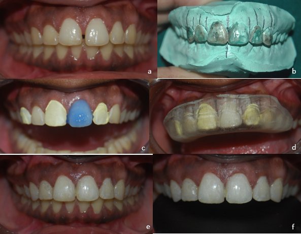 Case 3 a: Pre-op photograph; b: Diagnostic wax mock-up; c: Alternate tooth acid etching done; d: Transparent siloxane template placed; e,f: Post-op photographs after finishing and polishing