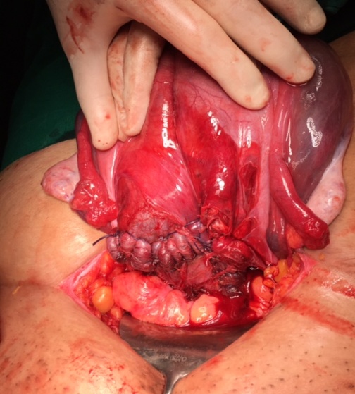 Repaired uterine incision and rent