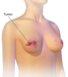 A typical hypothetical women`s breast-cancer
