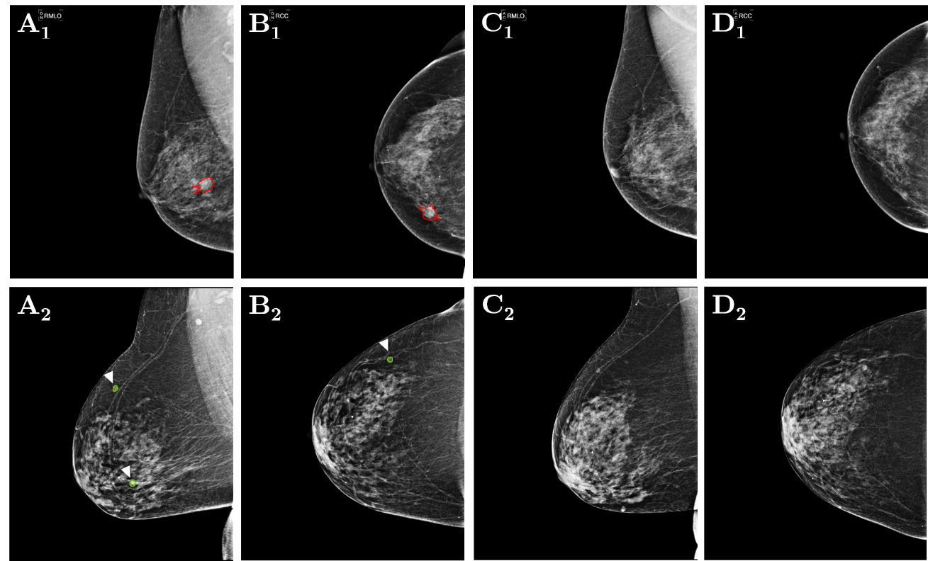 Illustrations of data sets. (1) The observations of a 64 year old female through the benign masses in the most recent mammograms BI-RADS breast-density-category(BDC) C (Case1, Upper-row) mammographically. (2) The observations of 70year old female through the BI-RADS BDC C (Case2, bottom-row). For every case ( ∀): (A): The most recent mammogram in Medio-Lateral-Oblique(MLO) Observation with accurate annotations of every-mass-breast-cancer tumor (red for biopsy-confirmed malignant mass, green for benign mass). (B): Latest mammogram in Cranio-Caudal(CC) observation through the accurate annotations of every breast-tumor-mass (red for biopsy-confirmed malignant-mass, green for benign-mass). (C): Preceding image of the MLO. (D): Preceding image of the CC.