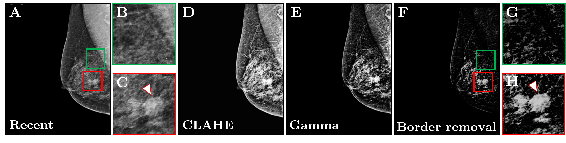 Effect of the pre-processing in a 64-year-old woman with BI-RADS breast density category c. (A) Original most recent image. (B) Zoomed region marked by the green square in A, showing an area without masses. (C) Zoomed region marked by the red square in A showing an area with a malignant mass (indicated by the arrow). (D) Image after CLAHE. (E) Image after gamma correction. (F) Final pre-processed image after border removal. (G) Zoomed region marked by the green square in F, showing the same area as B, after pre-processing. (H) Zoomed region marked by the red square in F, showing the same area as C, after pre-processing.
