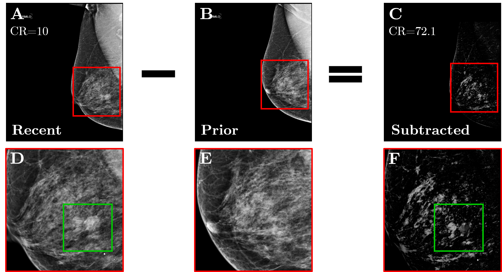Example of temporal subtraction in a 64-year-old woman with BI-RADS breast density category c. (A): Most recent mammogram. (B): Prior mammogram. (C): The result of subtracting the registered version of B from A. (D)-(F): Zoomed regions marked by the red squares in A-C, where the green squares enclose a new malignant mass that was not subtracted. The CR has increased 7 times after subtraction.