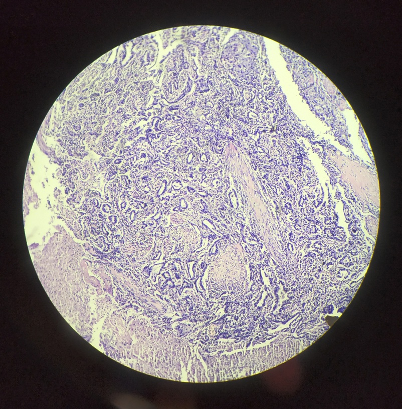Infiltrating urothelial carcinoma with glandular differentiation (arrow head) with Invasion into muscularis propria; H & E stain; 10x