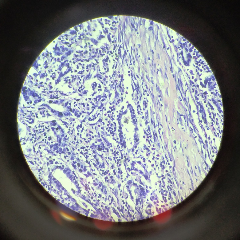 Infiltrating urothelial carcinoma with glandular differentiation (arrow head) with Invasion into muscularis propria; H & E stain; 40x