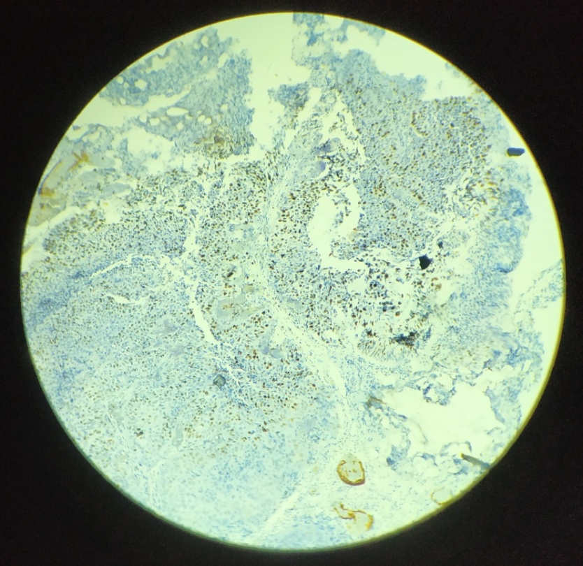 Infiltrating urothelial carcinoma showing score 3+ positive nuclear staining for Ki-67 marker; IHC; 10x