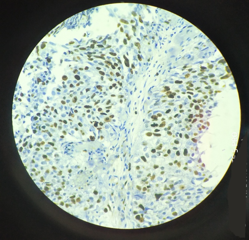 Infiltrating urothelial carcinoma showing score 3+ positive nuclear staining for Ki-67 marker; IHC; 10x (L)